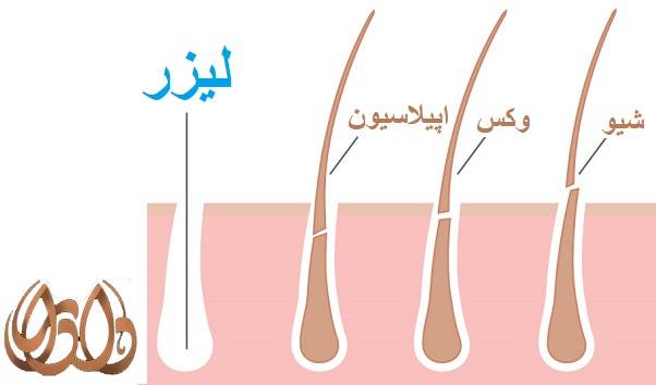 نکات مهم برای لیزر موهای زائد ناحیه تناسلی