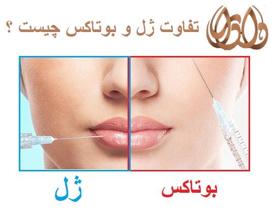 تفاوت ژل با بوتاکس