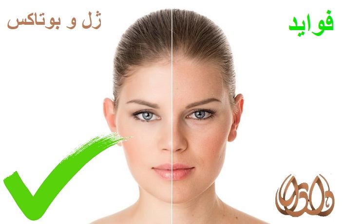 تزریق ژل و بوتاکس