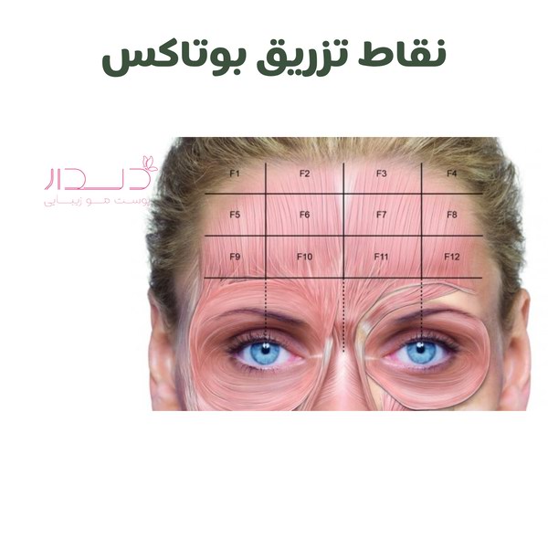 نقاط مناسب تزریق بوتاکس در صادقیه