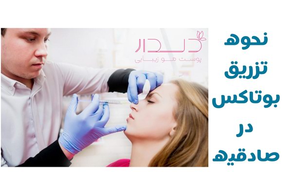 نحوه تزریق بوتاکس در صادقیه چگونه است