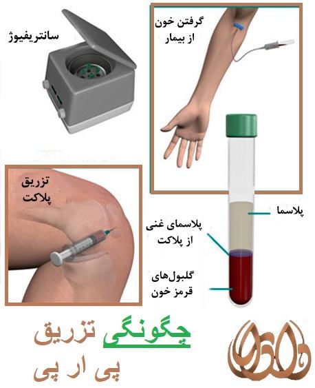 پی آر پی چگونه تزریق می شود؟