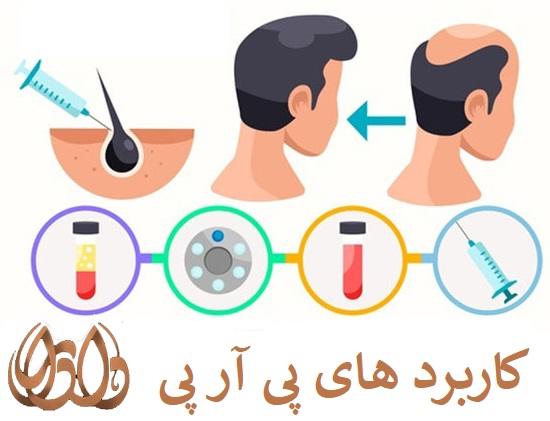 پی آر پی چه استفاده هایی دارد؟