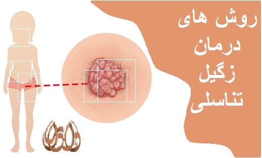 روش های درمان زگیل تناسلی