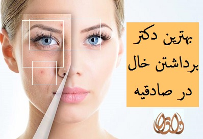 بهترین دکتر برداشتن خال در صادقیه