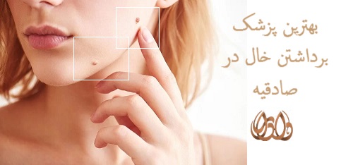 بھترین پزشک برداشتن خال در صادقیه