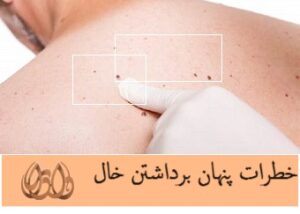 خطرات پنهان برداشتن خال