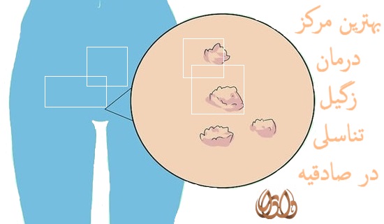 بهترین مرکز درمان زگیل تناسلی در صادقیه