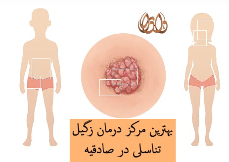 بهترین مرکز درمان زگیل تناسلی در صادقیه