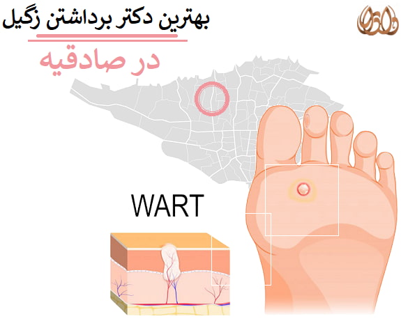 بهترین دکتر برداشتن زگیل در صادقیه