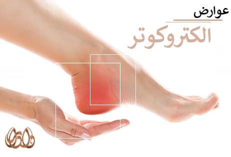 عوارض الکتروکوتر