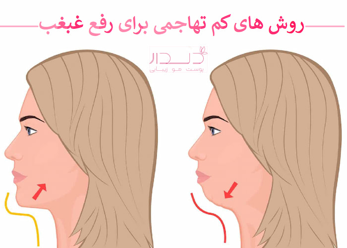 بهترین مرکز رفع غبغب در صادقیه