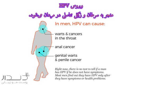 زمان درمان زگیل تناسلی در مردان