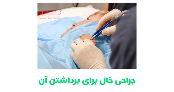 برداشتن خال با جراحی