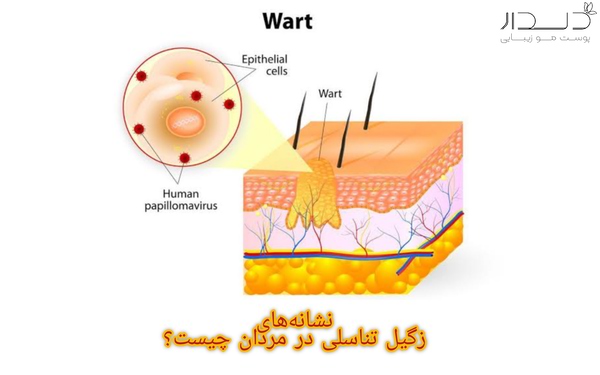 نشانه‌های زگیل تناسلی در مردان چیست؟