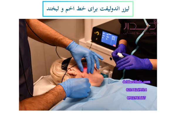 حذف خط اخم و لبخند با لیزر اندولیفت