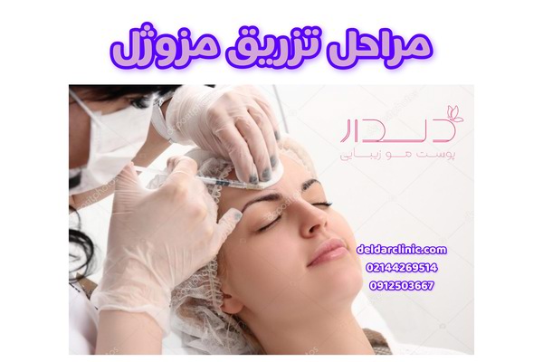 نحوه تزریق مزوژل