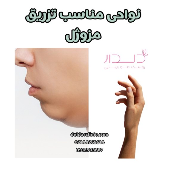 نواحی مناسب تزریق مزوژل