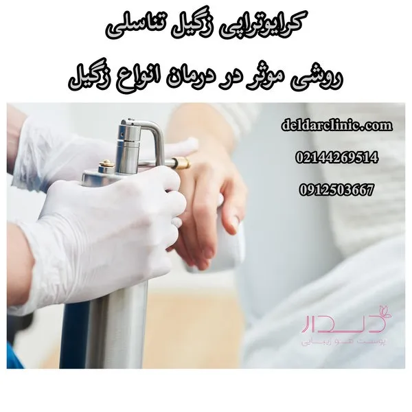 کرایوتراپی زگیل تناسلی