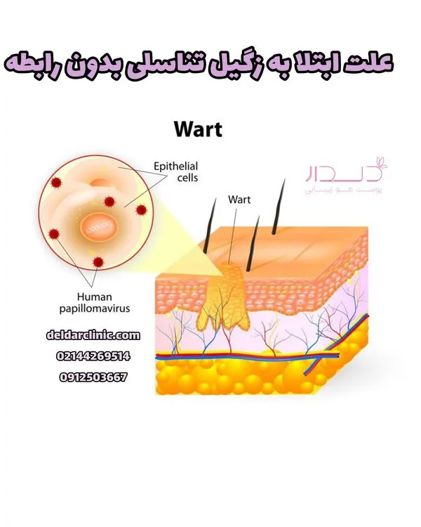 علت ابتلا به زگیل تناسلی بدون رابطه