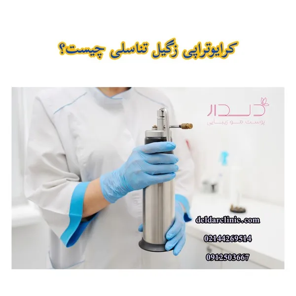 کرایوتراپی زگیل تناسلی چیست