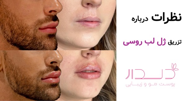 نظرات درباره تزریق ژل لب روسی