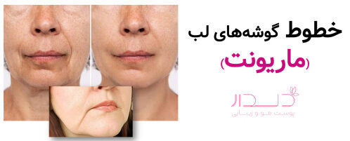 خطوط گوشه های لب به سمت پایین