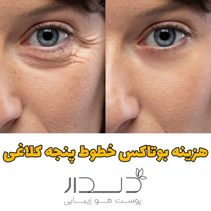 هزینه بوتاکس پنجه کلاغی