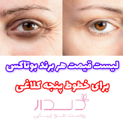 هزینه بوتاکس پنجه کلاغی