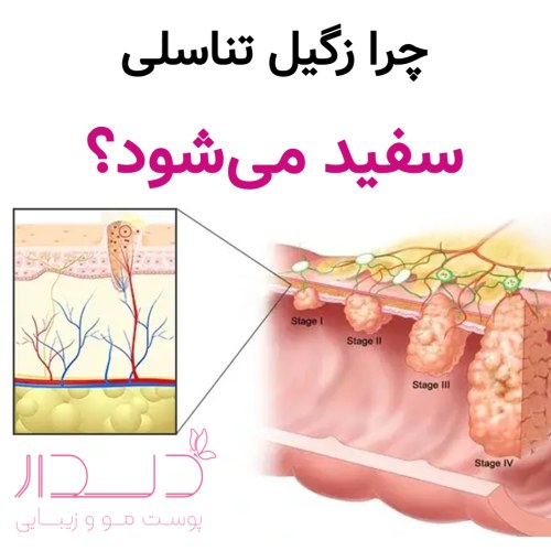 چرا زگیل تناسلی سفید می شود؟