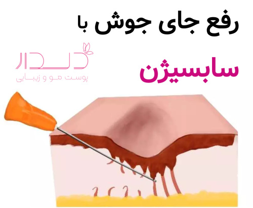 از بین بردن جای جوش با سابسیژن