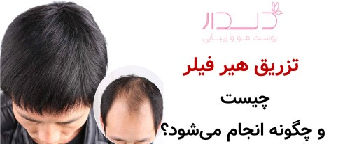 تزریق هیر فیلر چیست و چگونه انجام می‌شود