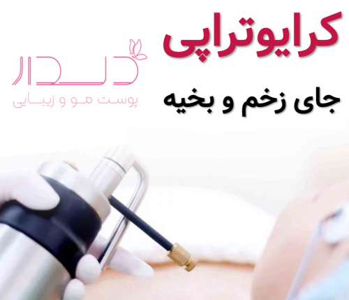 کرایوتراپی جای زخم و بخیه