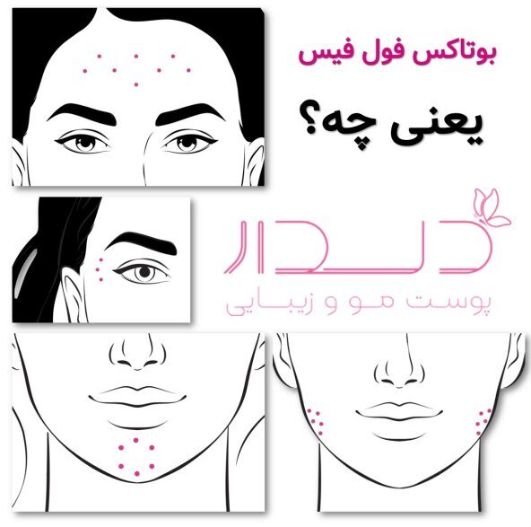 بوتاکس فول فیس یعنی چه؟