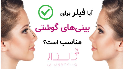 آیا فیلر برای بینی‌های گوشتی مناسب است؟