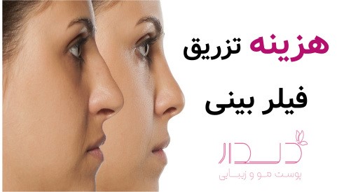 هزینه تزریق فیلر بینی