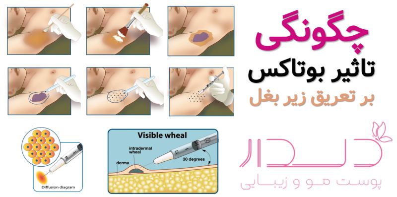 چگونه بوتاکس زیر بغل از تعریق جلوگیری می‌کند؟