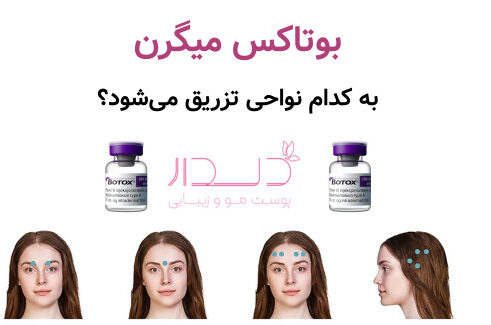 بوتاکس میگرن به کدام نواحی تزریق می‌شود؟