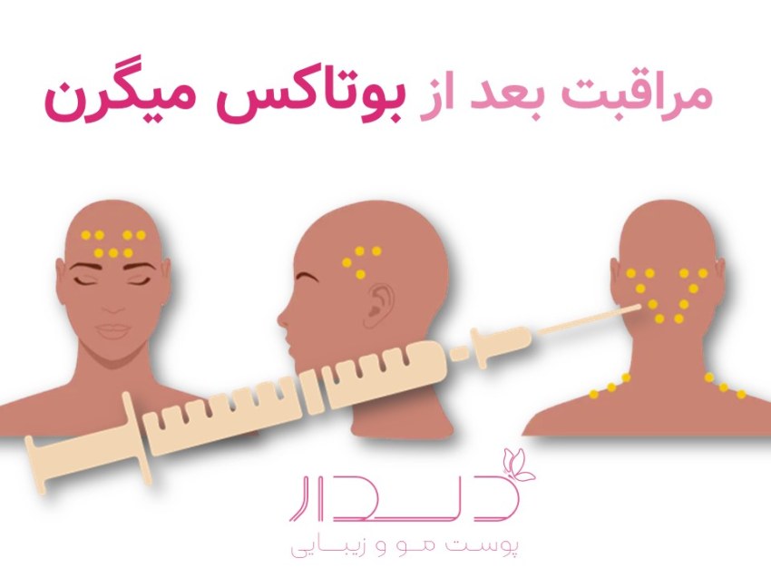 تزریق بوتاکس میگرن