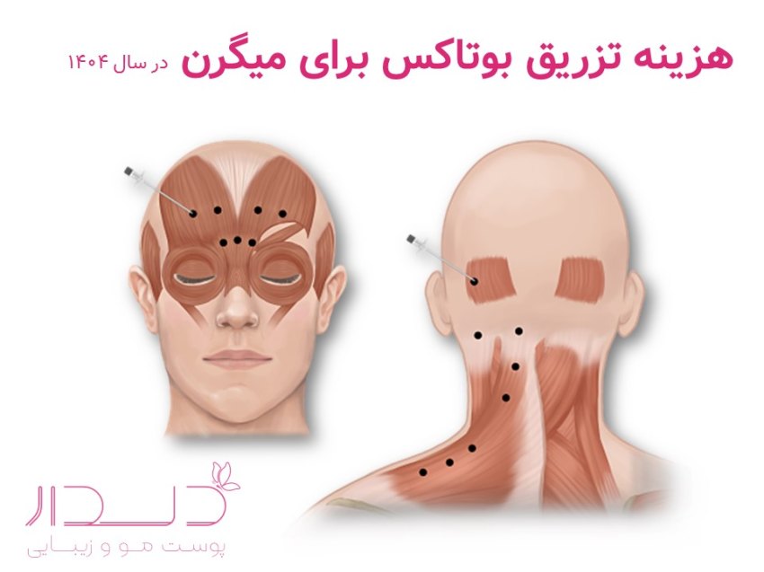هزینه بوتاکس میگرنی