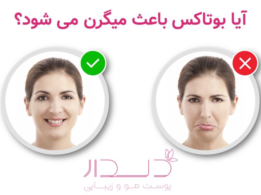 درد پس از بوتاکس میگرن