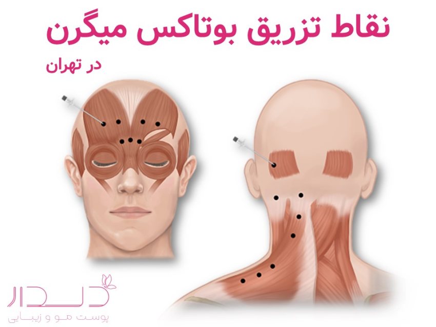 نقاط تزریق بوتاکس