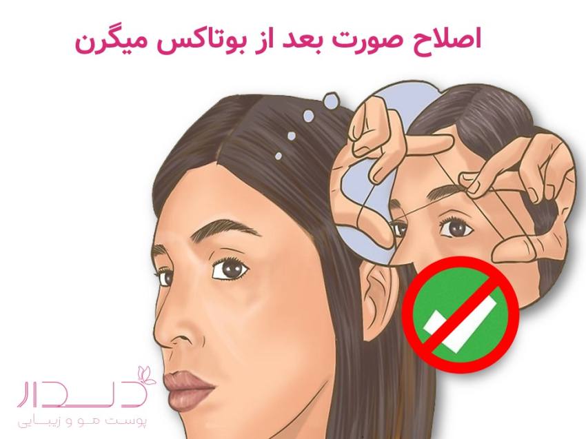 بند انداختن صورت پس از بوتاکس میگرن