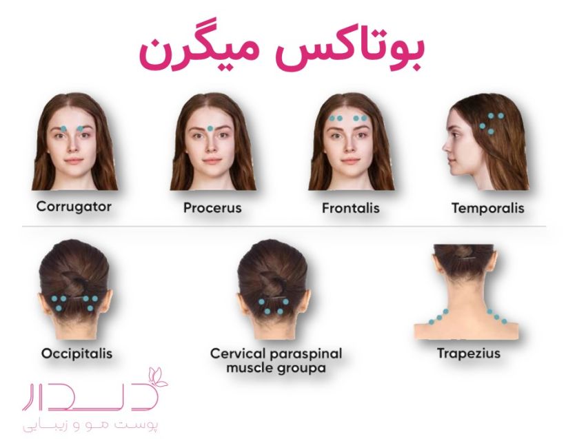بوتاکس زیبایی