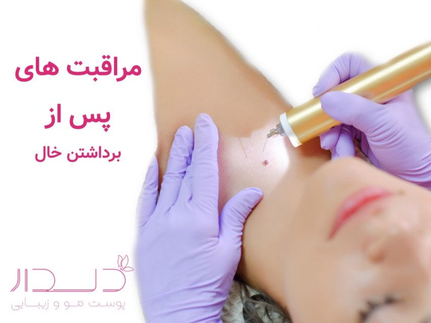 مراقبت های بعد از برداشتن خال