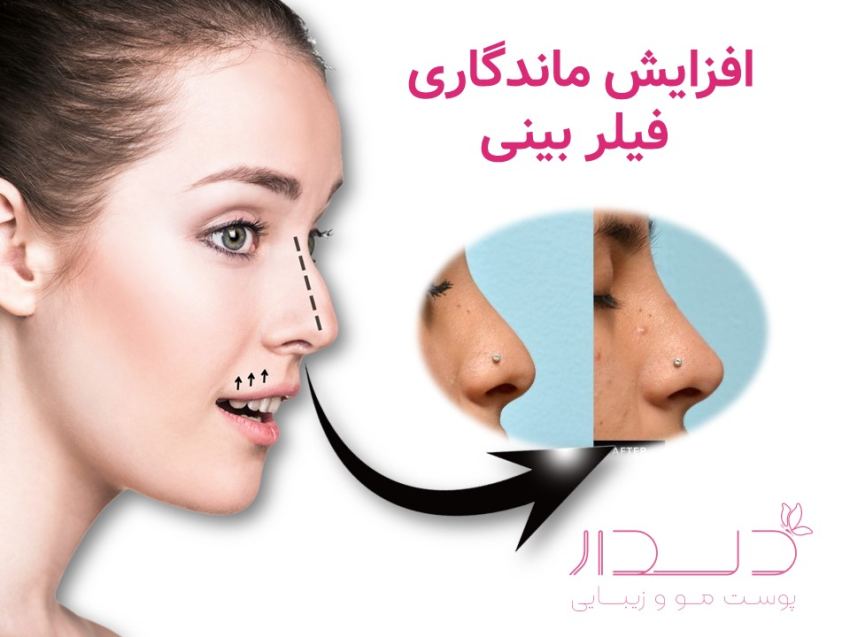 مراقبت های بعد از فیلر بینی