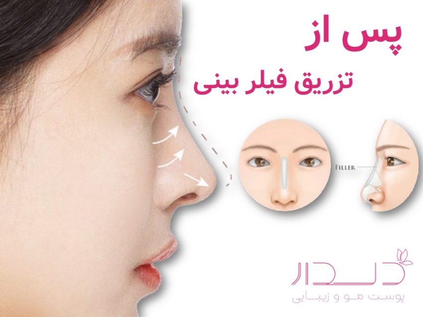 پس از تزریق فیلر بینی
