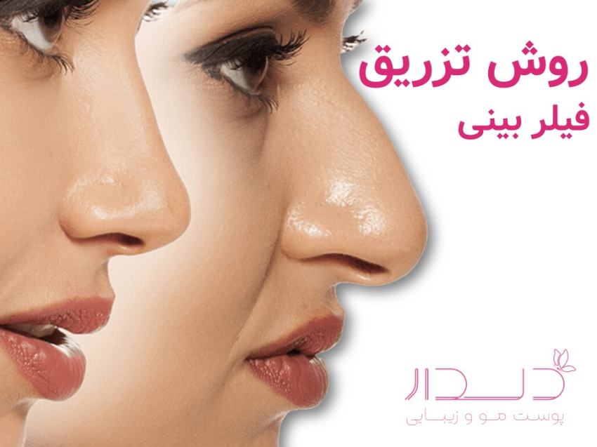 نحوه تزریق فیلر بینی
