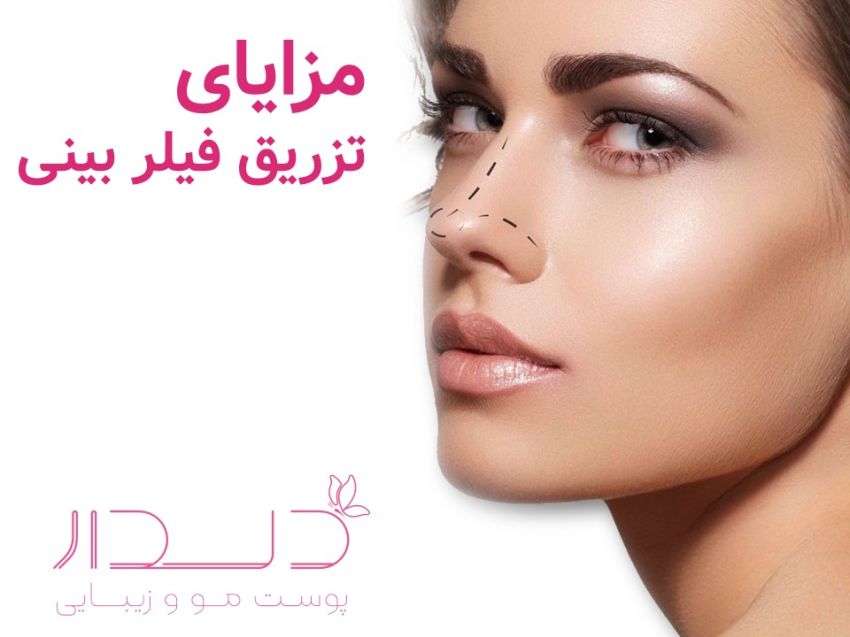مزایای فیلر بینی