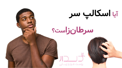 آیا اسکالپ سر سرطان‌زاست؟
